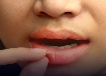 শীতে ঠোঁট ফেটে রক্ত বের হলে কী করবেন?
