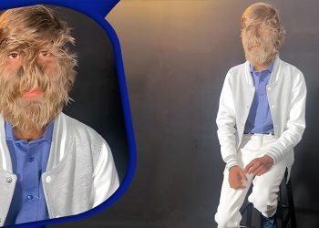 মুখের ৯৫ শতাংশের বেশি অংশ বড় লোমে ঢাকা তরুণের