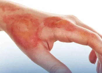 হঠাৎ পুড়ে গেলে কী করবেন