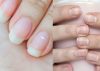 হাত ও পায়ের নখে সাদা দাগ, ক্যালসিয়ামের অভাব না অন্য কিছু?