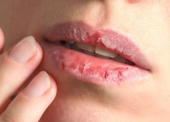 শীত এলেই ঠোঁট ও মুখে ঘা হয়? জানুন সমাধান