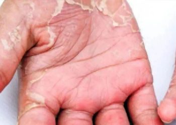শীতে হাতের চামড়া উঠে যাচ্ছে? রক্ষা পাবেন যেভাবে