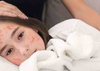 হাম হলে শিশুকে কী খাওয়াবেন, কোন খাবার থেকে দূরে রাখবেন