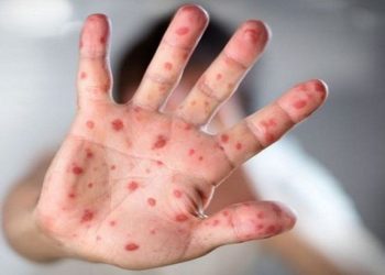 হামে আক্রান্ত শিশুকে যা খাওয়াবেন